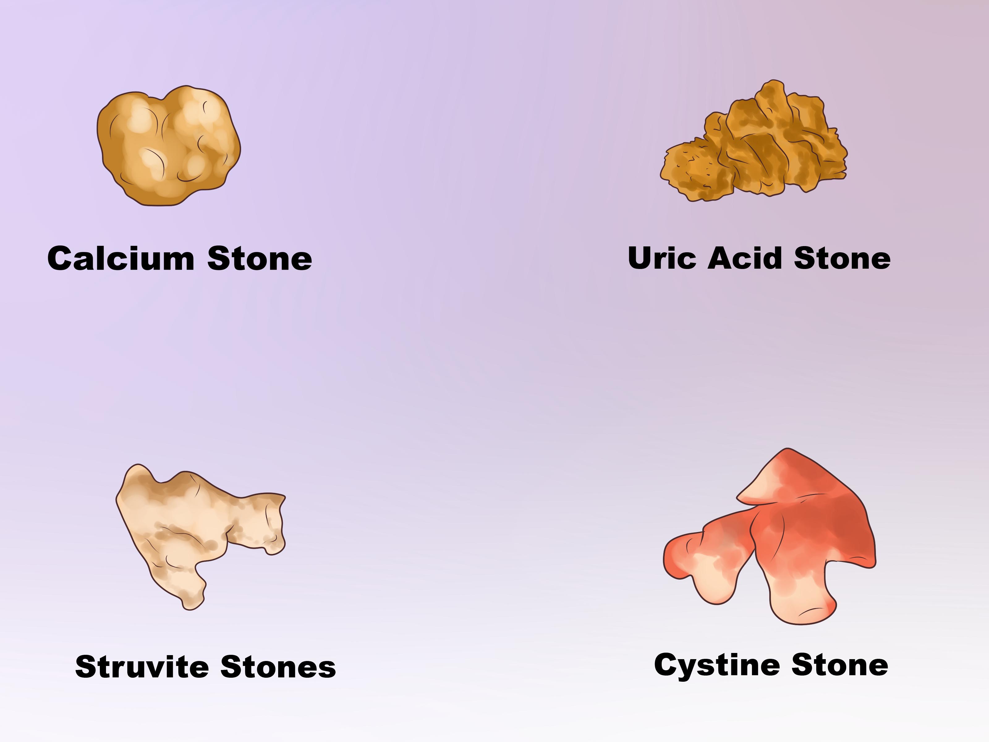 4 loại sỏi thường gặp là: Sỏi canxi, sỏi cystin, sỏi axit uric và sỏi struvite